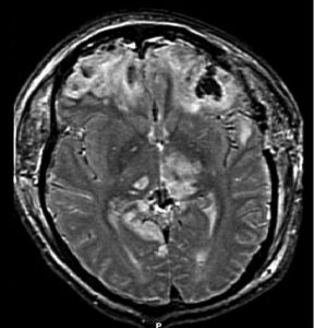 576px-brain_injury_with_herniation_mri